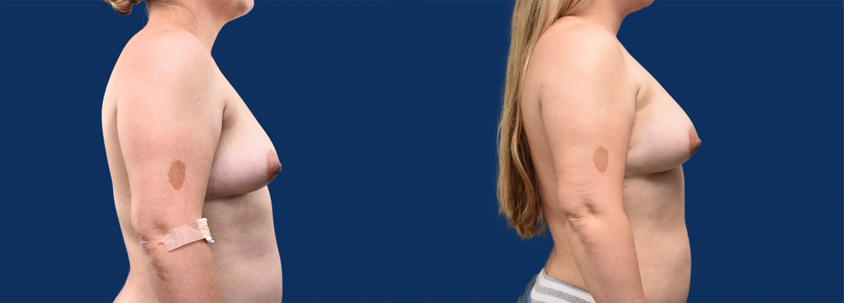 Real Patient Results of Dr. Wilson of Lake Norman Plastic Surgery