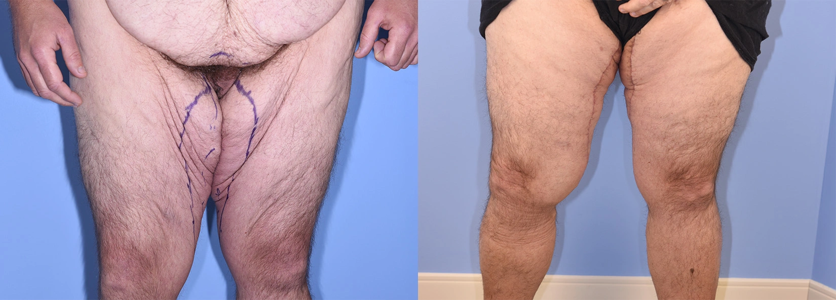 Real Patient Results of Dr. Wilson of Lake Norman Plastic Surgery