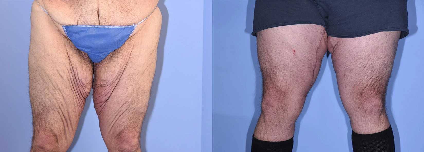 Real Patient Results of Dr. Wilson of Lake Norman Plastic Surgery