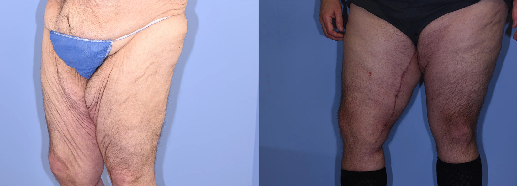 Real Patient Results of Dr. Wilson of Lake Norman Plastic Surgery