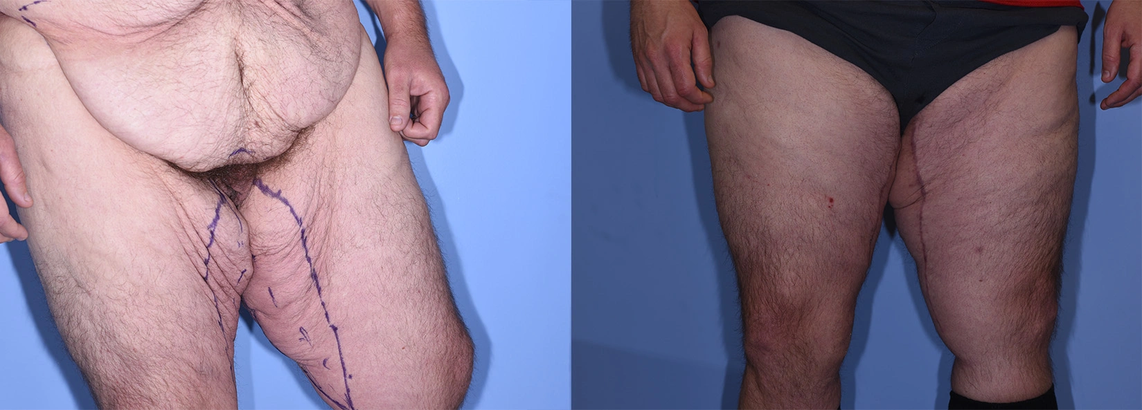 Real Patient Results of Dr. Wilson of Lake Norman Plastic Surgery