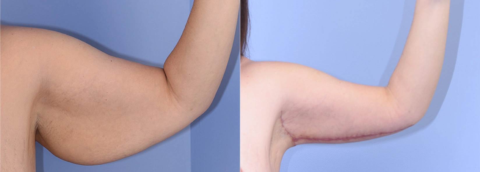 Real Patient Results of Dr. Wilson of Lake Norman Plastic Surgery