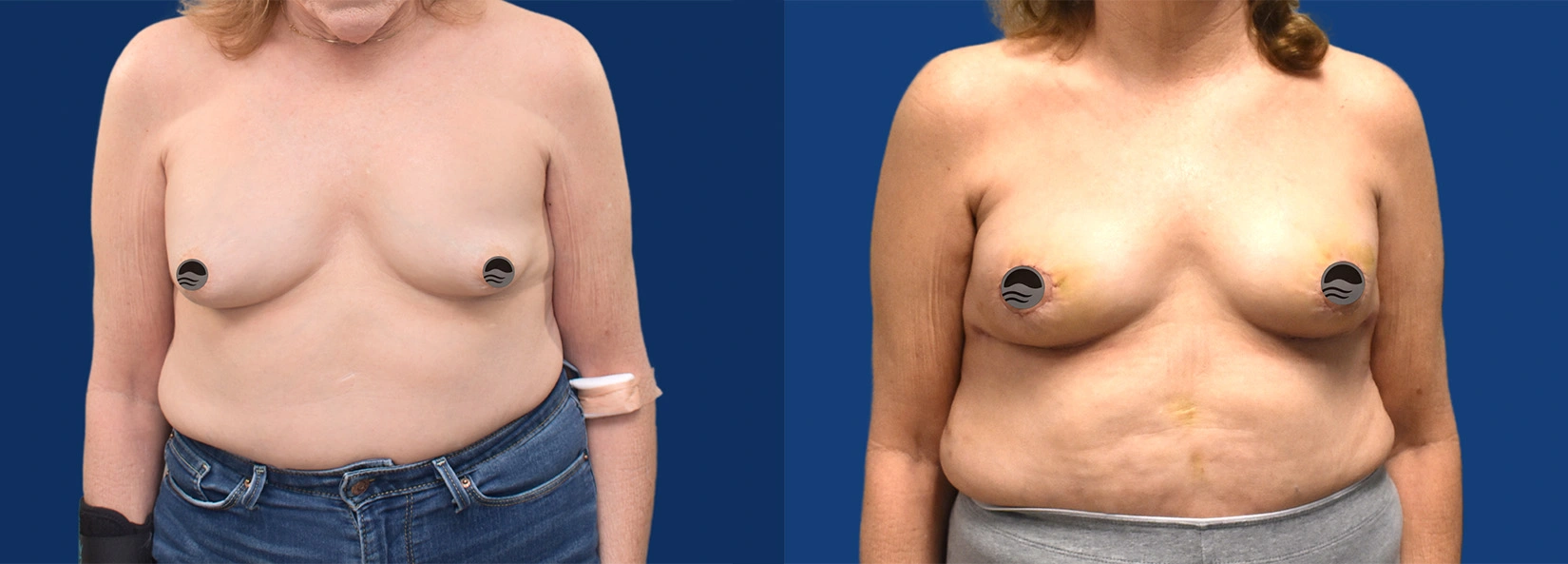 Real Patient Results of Dr. Wilson of Lake Norman Plastic Surgery