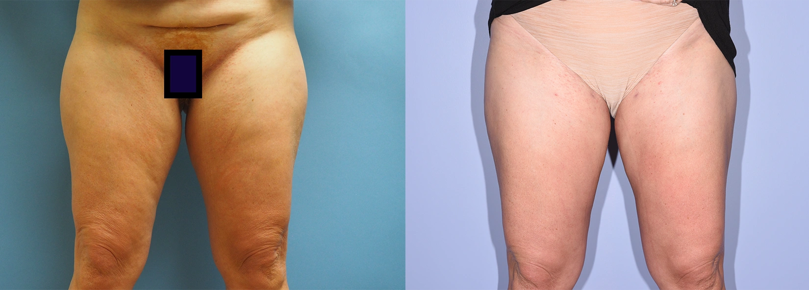 Real Patient Results of Dr. Wilson of Lake Norman Plastic Surgery