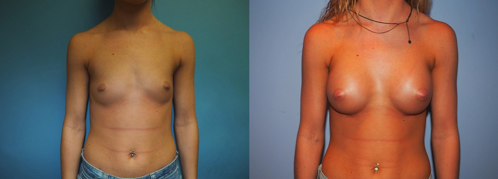 Real Patient Results of Dr. Wilson of Lake Norman Plastic Surgery