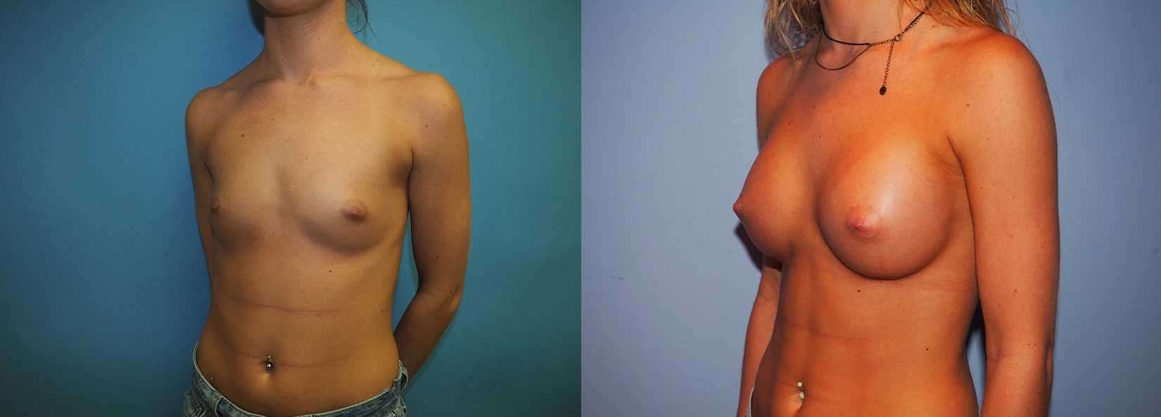 Real Patient Results of Dr. Wilson of Lake Norman Plastic Surgery