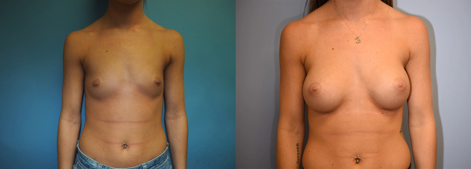 Real Patient Results of Dr. Wilson of Lake Norman Plastic Surgery