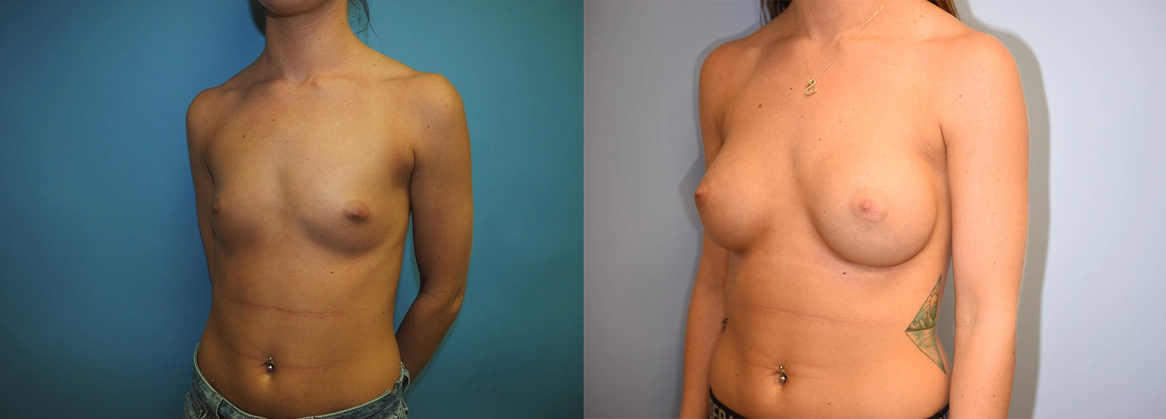 Real Patient Results of Dr. Wilson of Lake Norman Plastic Surgery