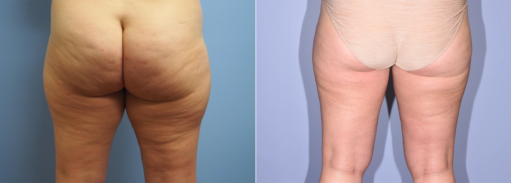 Real Patient Results of Dr. Wilson of Lake Norman Plastic Surgery