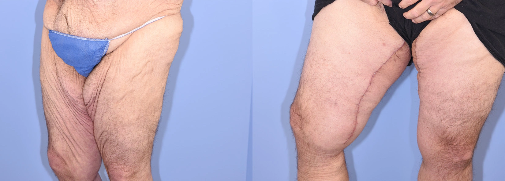 Real Patient Results of Dr. Wilson of Lake Norman Plastic Surgery