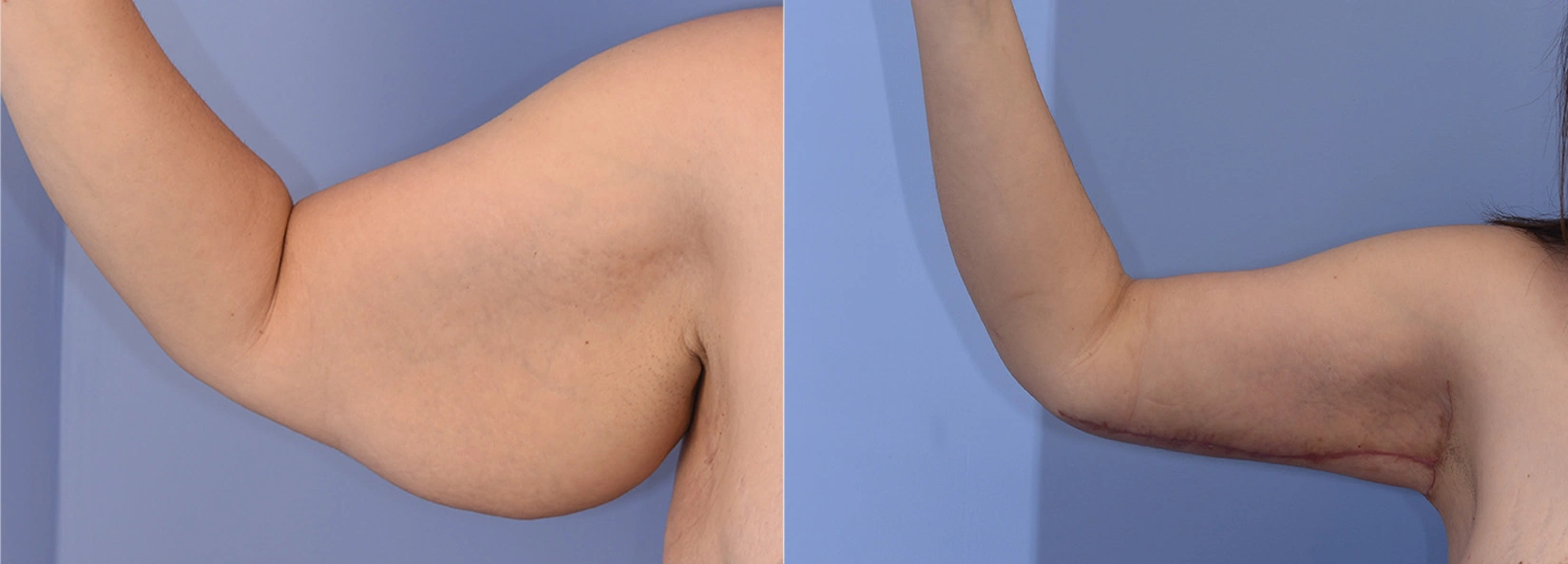 Real Patient Results of Dr. Wilson of Lake Norman Plastic Surgery