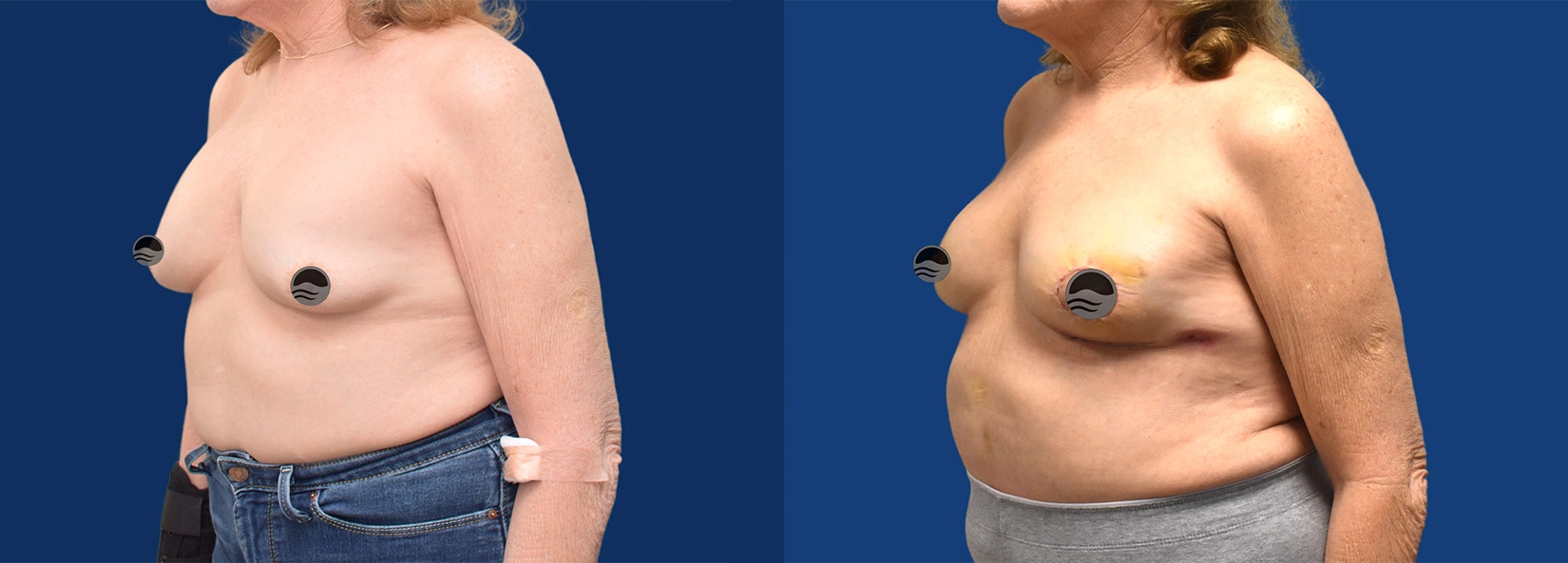 Real Patient Results of Dr. Wilson of Lake Norman Plastic Surgery