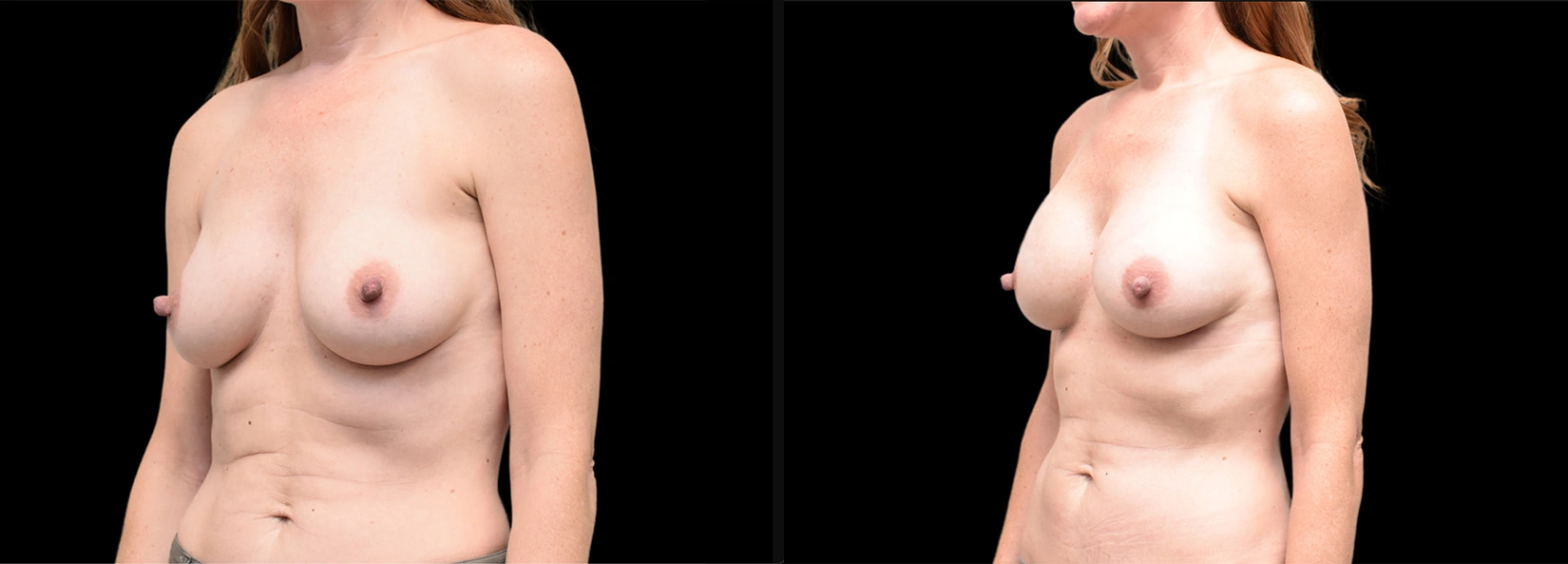 Real Patient Results of Dr. Wilson of Lake Norman Plastic Surgery