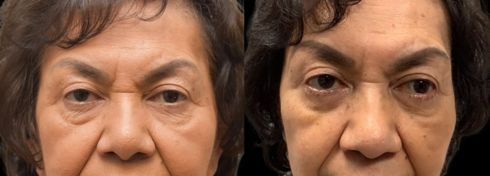 Real Patient Results of Dr. Wilson of Lake Norman Plastic Surgery