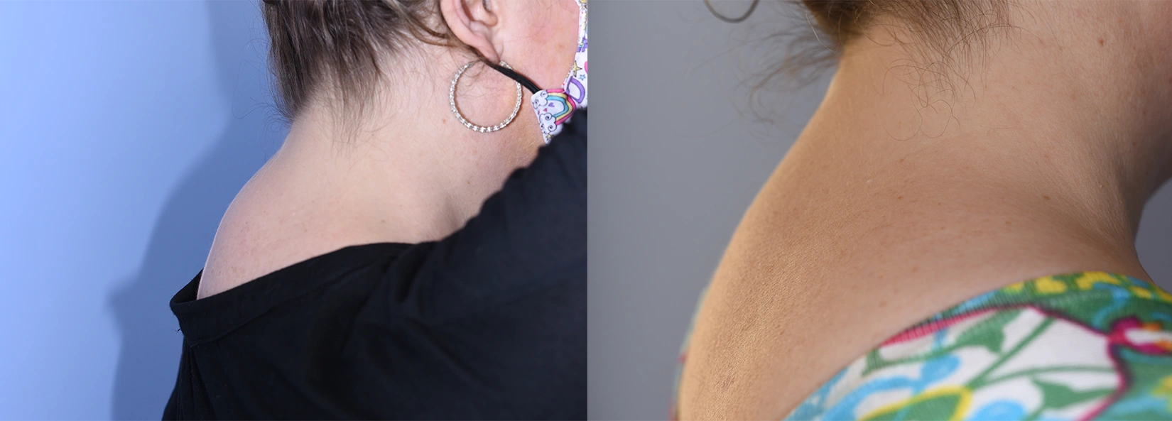 Real Patient Results of Dr. Wilson of Lake Norman Plastic Surgery