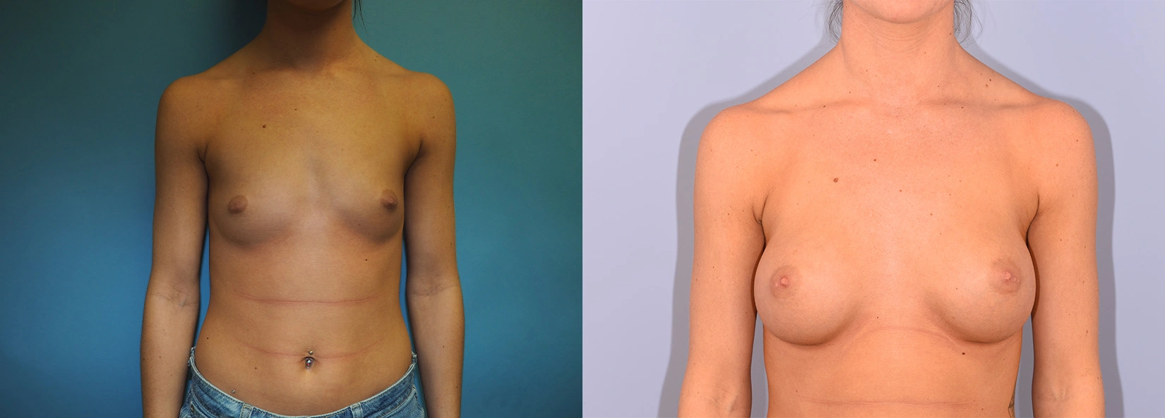 Real Patient Results of Dr. Wilson of Lake Norman Plastic Surgery