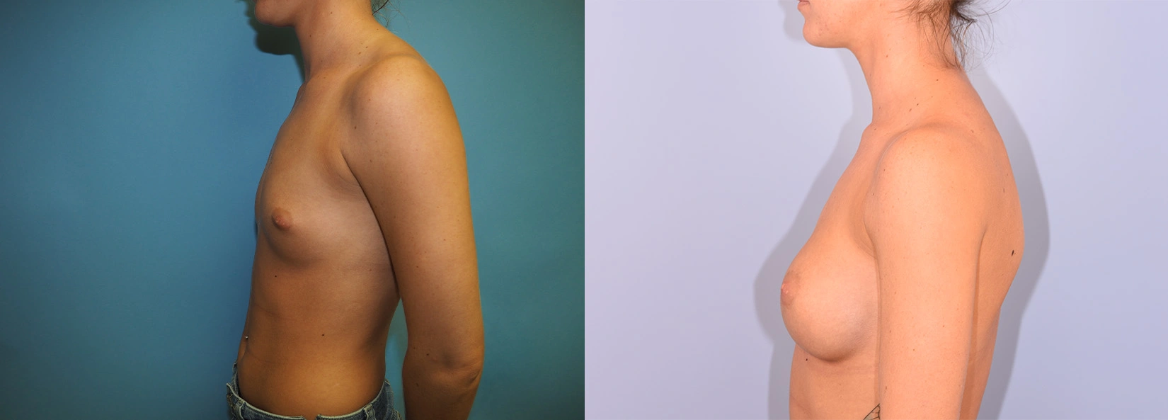 Real Patient Results of Dr. Wilson of Lake Norman Plastic Surgery