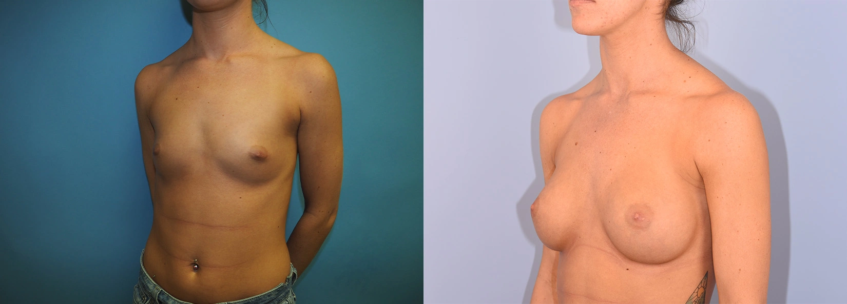 Real Patient Results of Dr. Wilson of Lake Norman Plastic Surgery