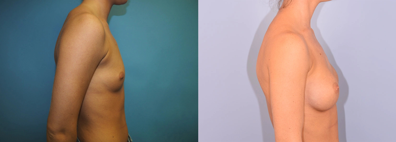 Real Patient Results of Dr. Wilson of Lake Norman Plastic Surgery