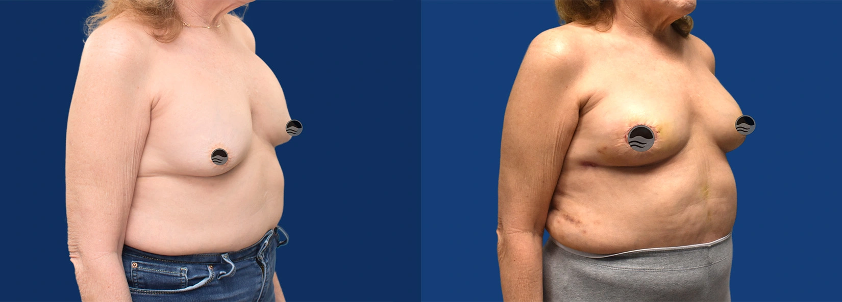 Real Patient Results of Dr. Wilson of Lake Norman Plastic Surgery