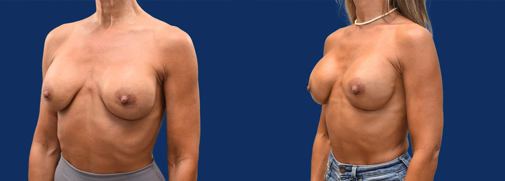 Real Patient Results of Dr. Wilson of Lake Norman Plastic Surgery