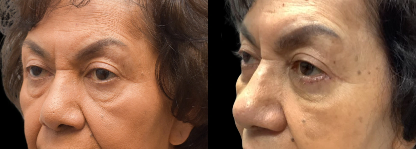 Real Patient Results of Dr. Wilson of Lake Norman Plastic Surgery