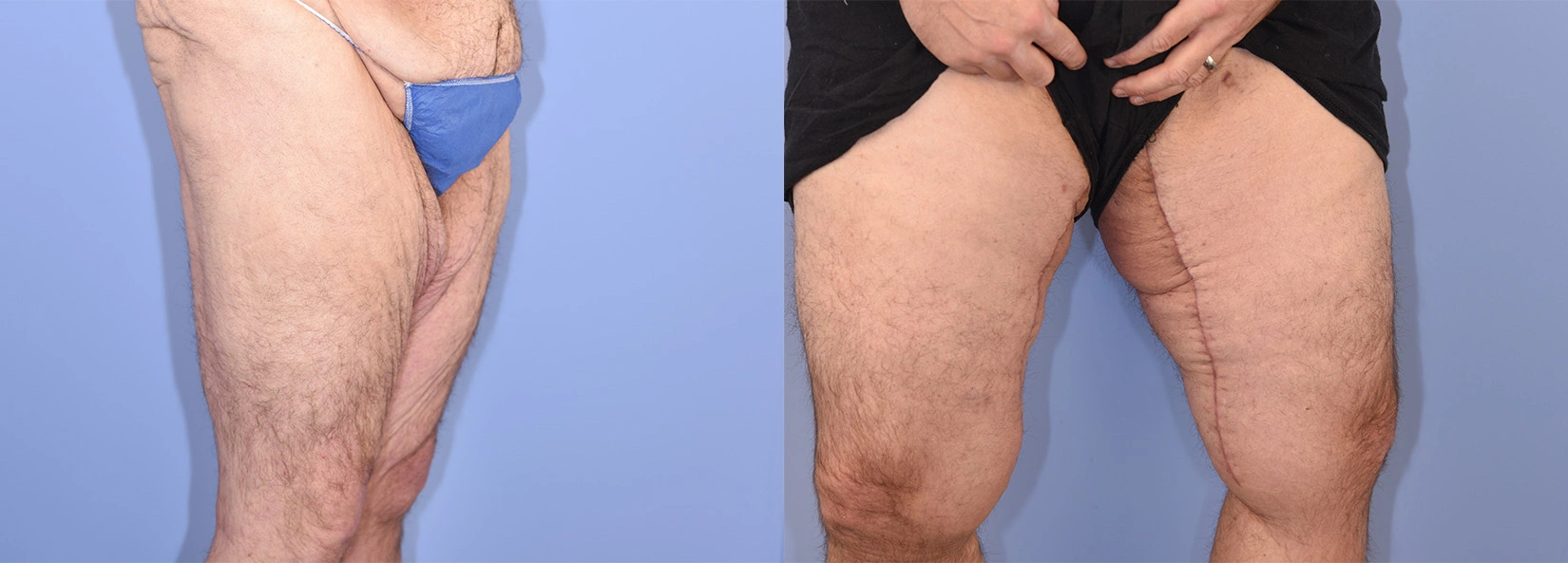 Real Patient Results of Dr. Wilson of Lake Norman Plastic Surgery