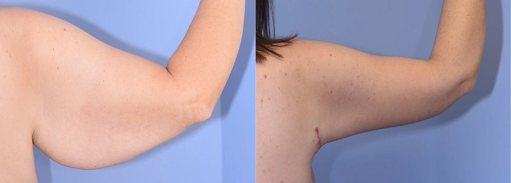 Real Patient Results of Dr. Wilson of Lake Norman Plastic Surgery