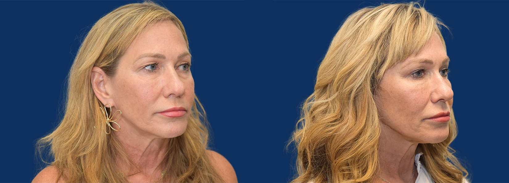 Real Patient Results of Dr. Wilson of Lake Norman Plastic Surgery