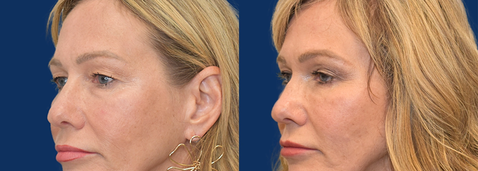 Real Patient Results of Dr. Wilson of Lake Norman Plastic Surgery