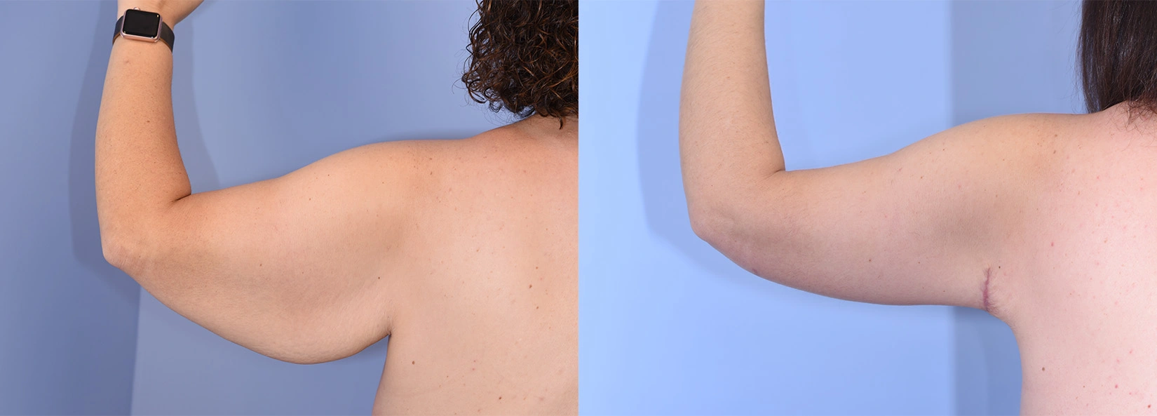 Real Patient Results of Dr. Wilson of Lake Norman Plastic Surgery