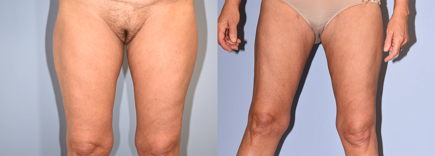 Real Patient Results of Dr. Wilson of Lake Norman Plastic Surgery