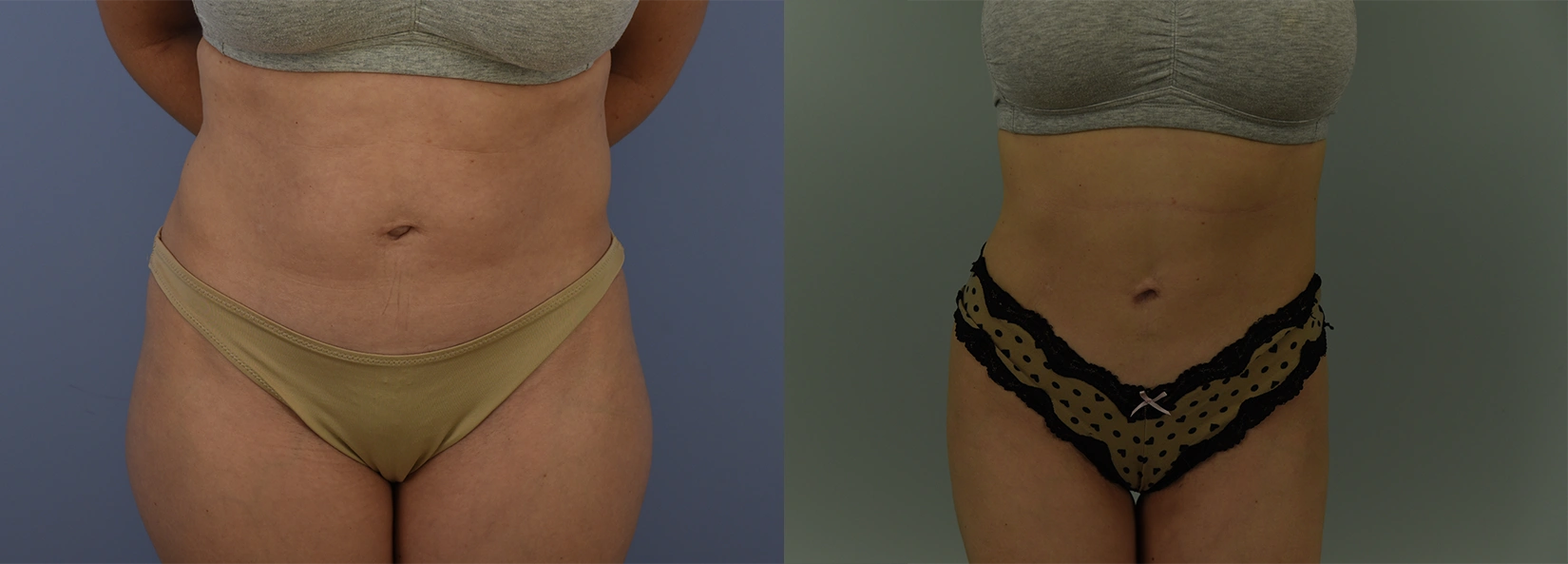 Real Patient Results of Dr. Wilson of Lake Norman Plastic Surgery