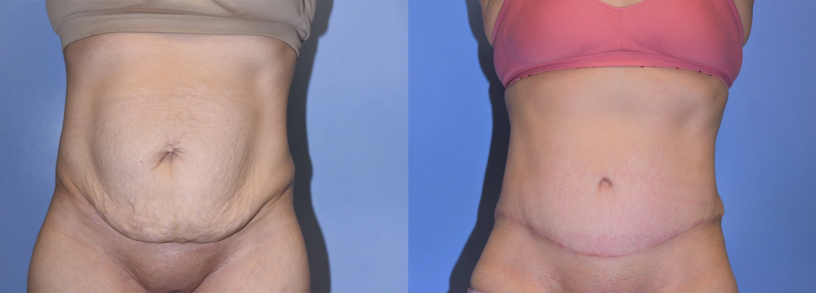 Real Patient Results of Dr. Wilson of Lake Norman Plastic Surgery