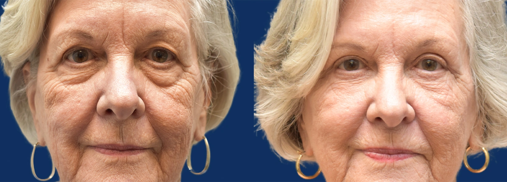 Real Patient Results of Dr. Wilson of Lake Norman Plastic Surgery