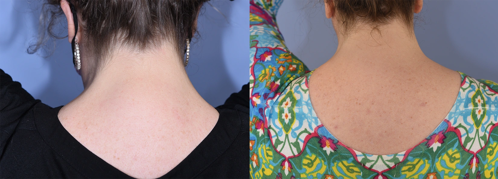 Real Patient Results of Dr. Wilson of Lake Norman Plastic Surgery