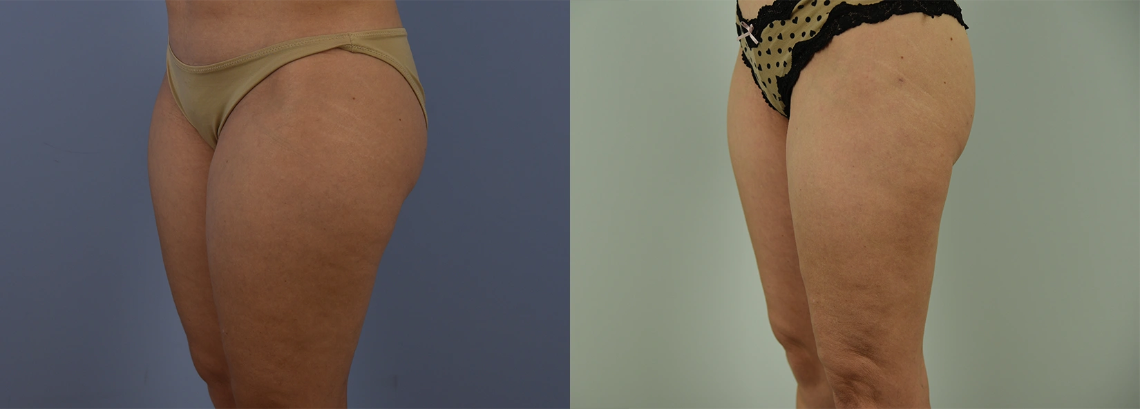 Real Patient Results of Dr. Wilson of Lake Norman Plastic Surgery