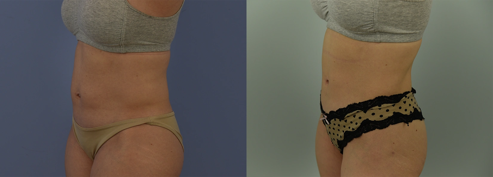 Real Patient Results of Dr. Wilson of Lake Norman Plastic Surgery