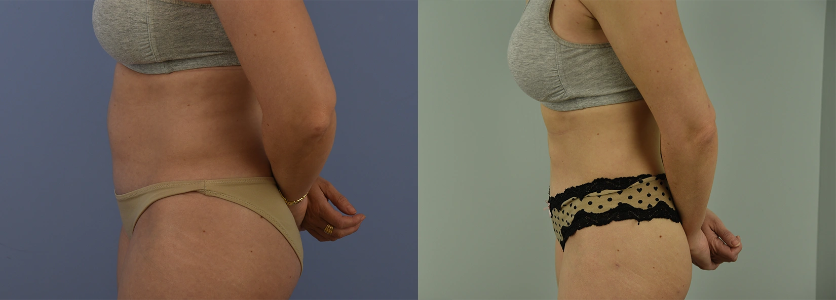 Real Patient Results of Dr. Wilson of Lake Norman Plastic Surgery