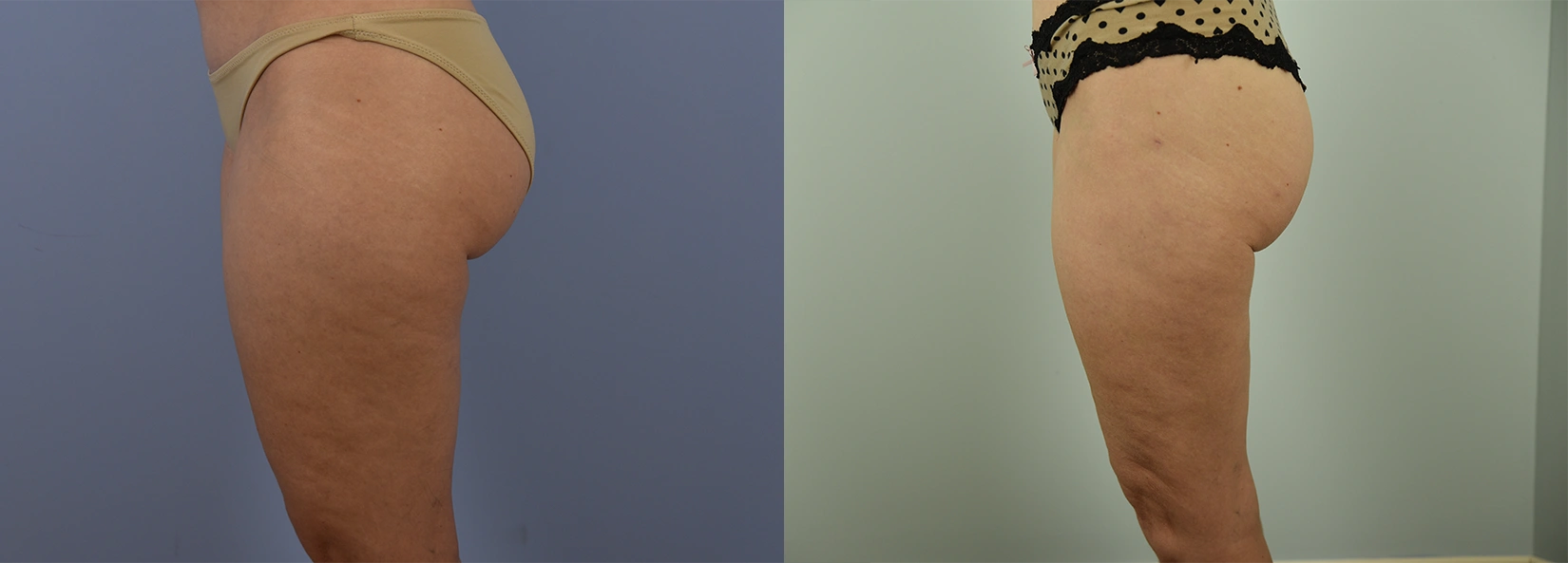 Real Patient Results of Dr. Wilson of Lake Norman Plastic Surgery