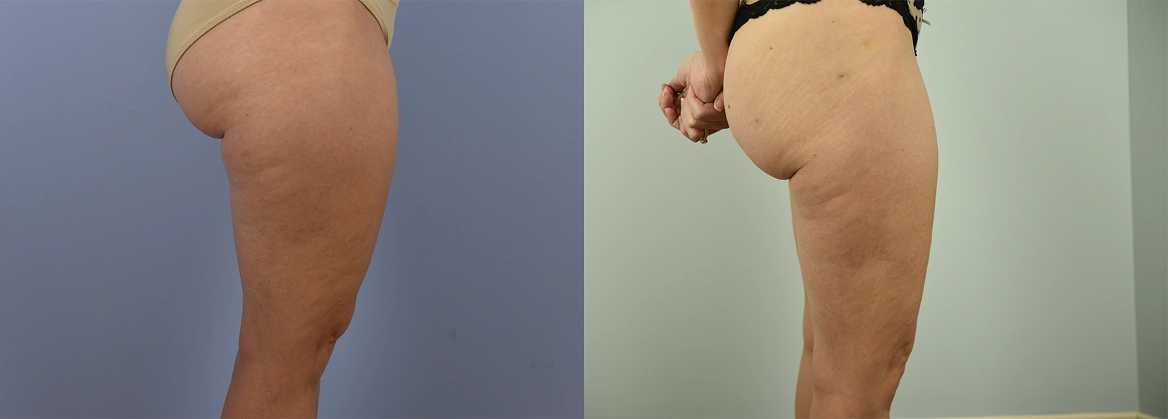 Real Patient Results of Dr. Wilson of Lake Norman Plastic Surgery