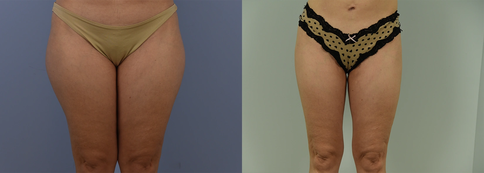 Real Patient Results of Dr. Wilson of Lake Norman Plastic Surgery