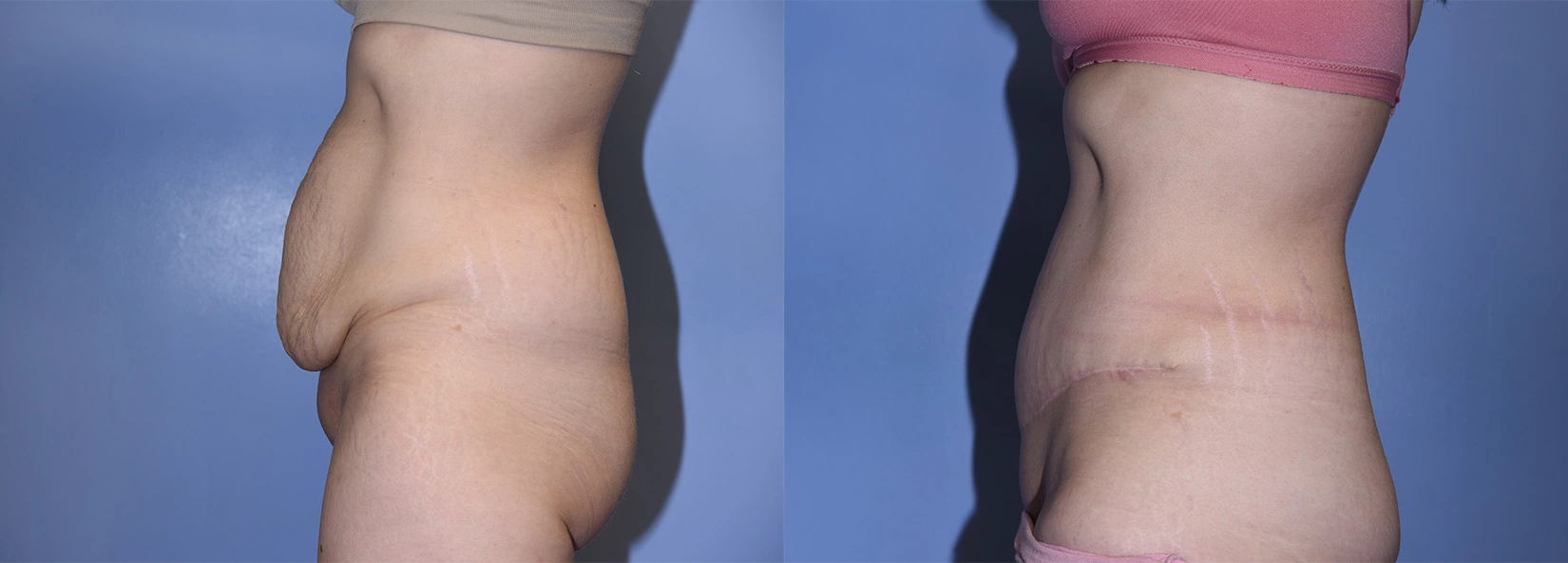 Real Patient Results of Dr. Wilson of Lake Norman Plastic Surgery