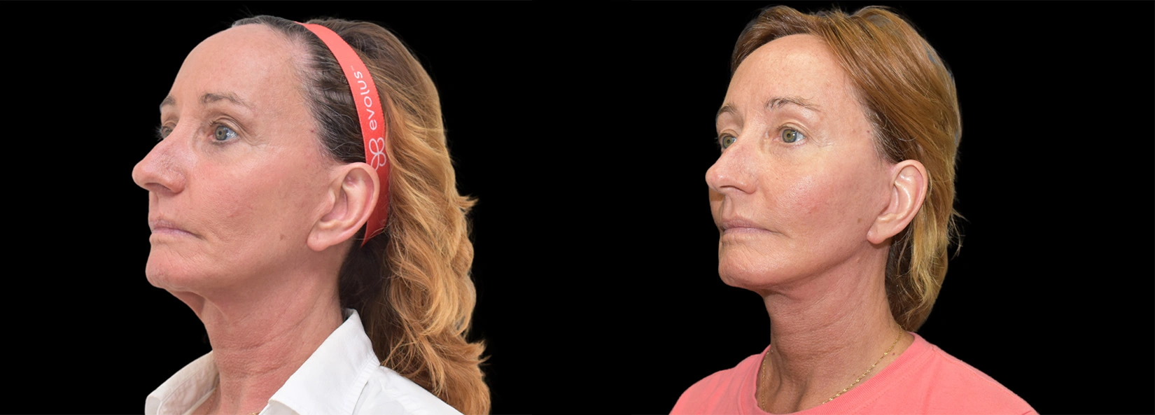 Real Patient Results of Dr. Wilson of Lake Norman Plastic Surgery