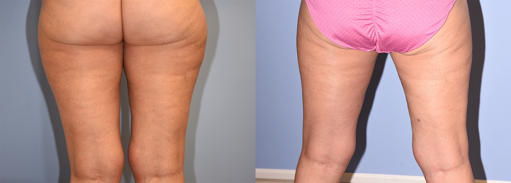 Real Patient Results of Dr. Wilson of Lake Norman Plastic Surgery