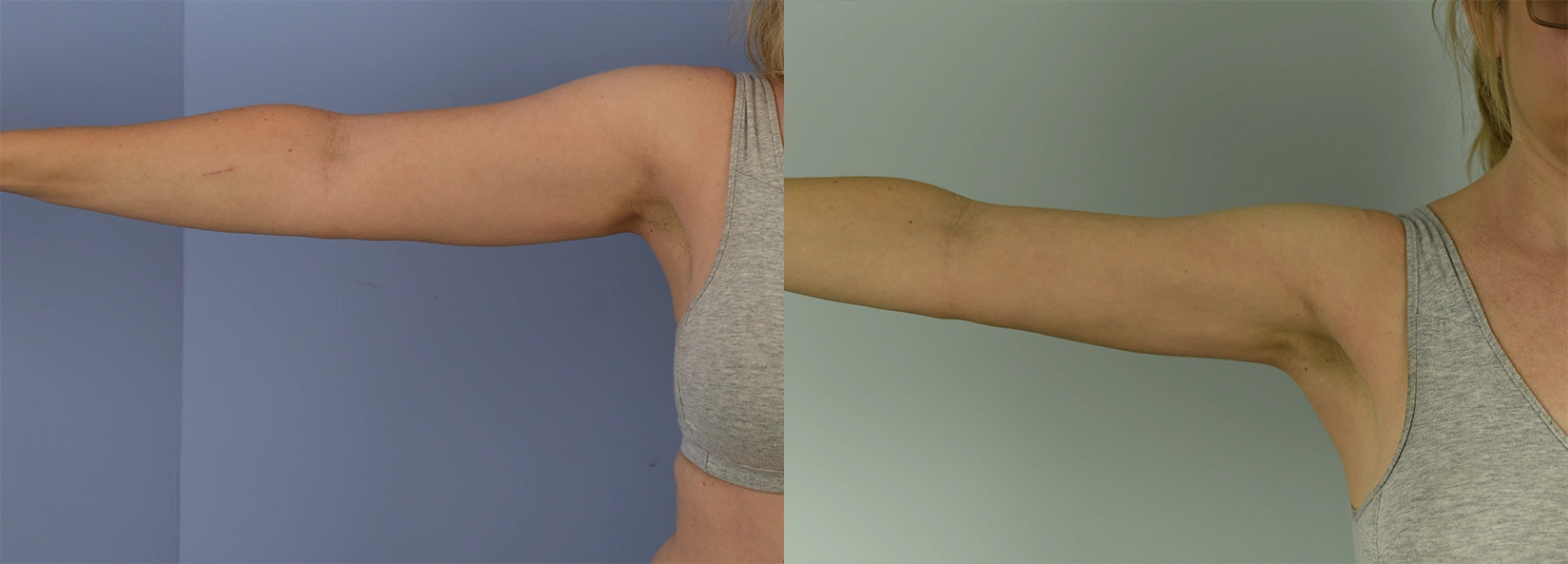 Real Patient Results of Dr. Wilson of Lake Norman Plastic Surgery