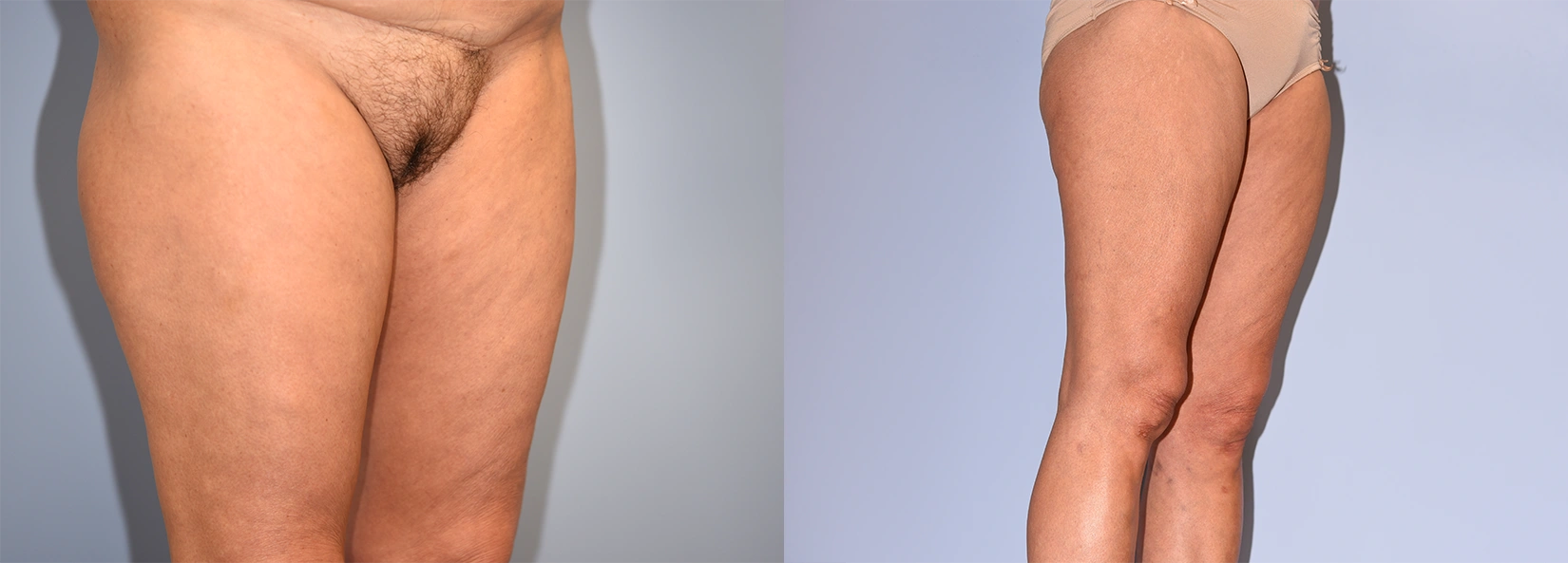 Real Patient Results of Dr. Wilson of Lake Norman Plastic Surgery