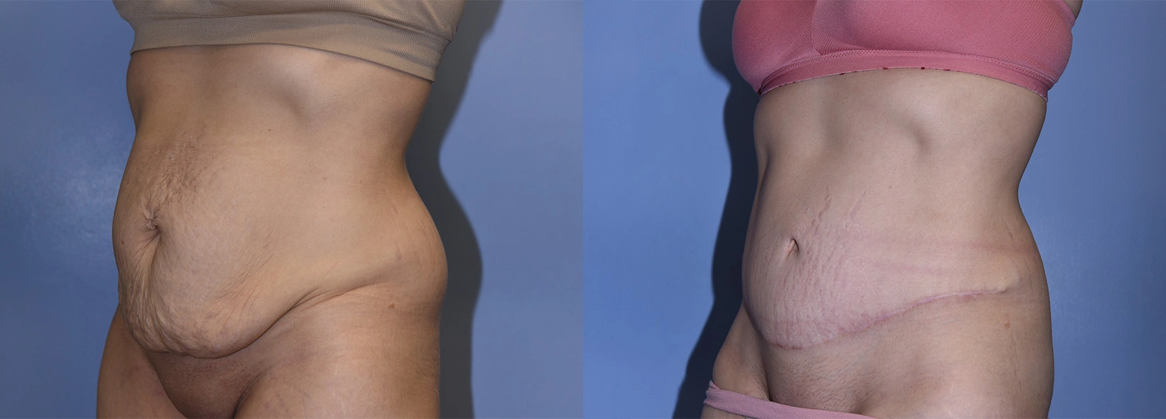 Real Patient Results of Dr. Wilson of Lake Norman Plastic Surgery