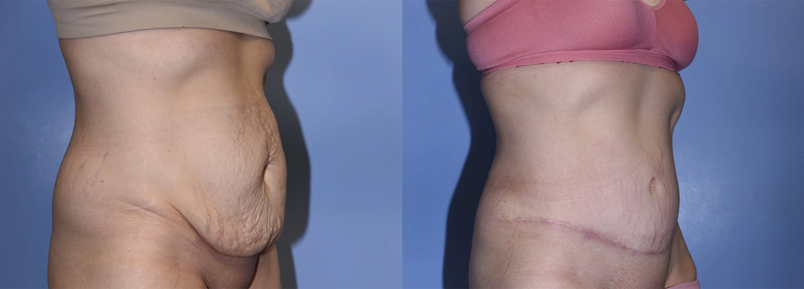 Real Patient Results of Dr. Wilson of Lake Norman Plastic Surgery