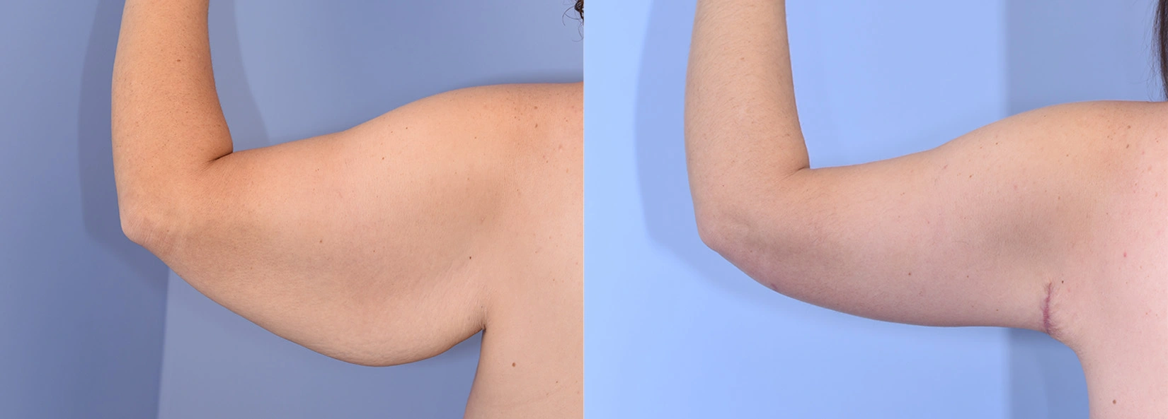 Real Patient Results of Dr. Wilson of Lake Norman Plastic Surgery